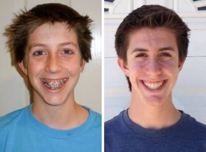 20 bức ảnh chứng minh niềng răng thay đổi nụ cười của bạn ra sao - Ảnh 20.