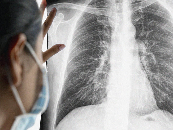 2 yếu tố tăng nguy cơ mắc ung thư phổi đang 'bùa vây' người Việt: Cách đơn giản để phòng tránh - Ảnh 1.