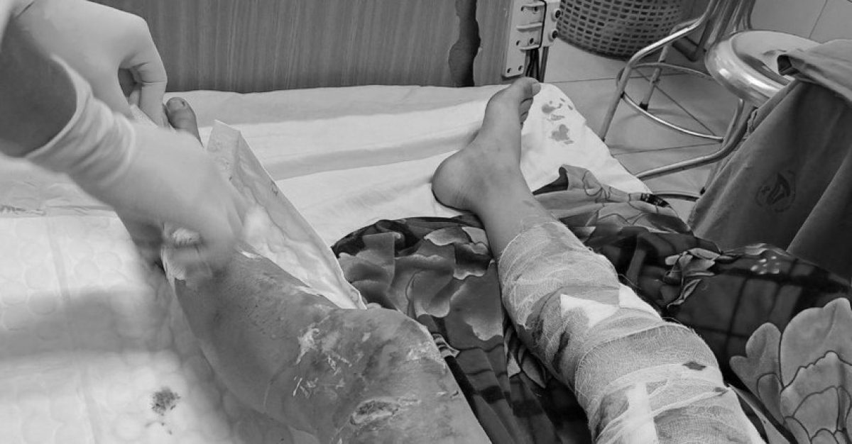 Tin mới nhất vụ nam sinh bị chó cắn đa chấn thương trong lúc chạy bộ ở Lào Cai - Ảnh 2.