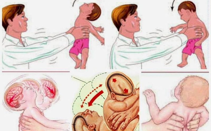 Cứu sống bé trai 4 tháng tuổi xuất huyết não do bị người thân bế xốc, rung lắc mạnh - Ảnh 2.