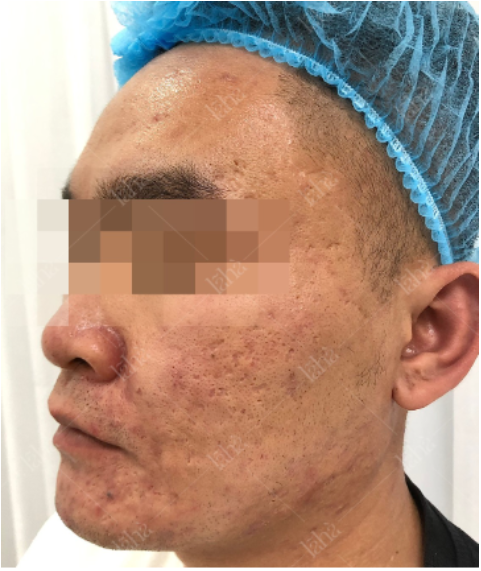 TS.BS da liễu Lã Hà bật mí tuyệt chiêu thanh lý sẹo mụn - Ảnh 1.