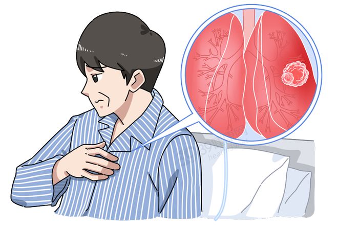 Người đàn ông bị đau vai suốt nửa năm, đi khám phát hiện mắc ung thư phổi – Bác sĩ chỉ ra 4 vị trí trên cơ thể xuất hiện cơn đau không được coi thường - Ảnh 2.