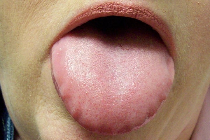 5 dấu hiệu ở lưỡi cảnh báo bệnh ung thư - Ảnh 1.