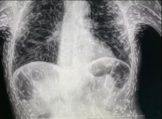 Xem ảnh X-quang của bệnh nhân bị ho, bác sĩ phát hiện 'thủ phạm' đáng sợ - Ảnh 1.