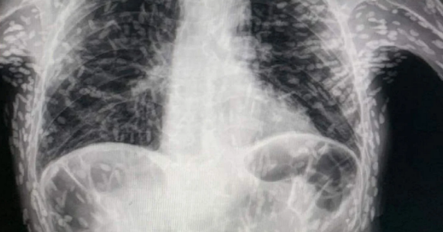 Đi chụp X-quang, người đàn ông tá hỏa vì khắp người toàn ký sinh trùng: Cảnh báo những món ăn quen thuộc chứa nhiều giun sán bậc nhất - Ảnh 1.