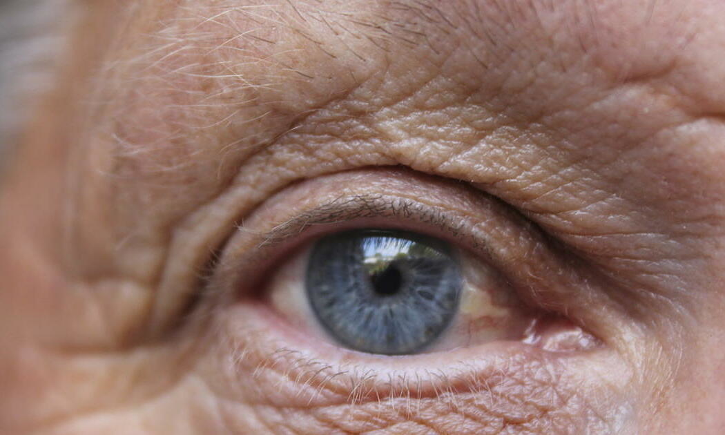 Sáng thức dậy mà có dấu hiệu này ở mắt, coi chừng đột quỵ mắt “ghé thăm” - Ảnh 1. Sáng thức dậy mà có dấu hiệu này ở mắt, coi chừng đột quỵ mắt “ghé thăm” - Ảnh 1.