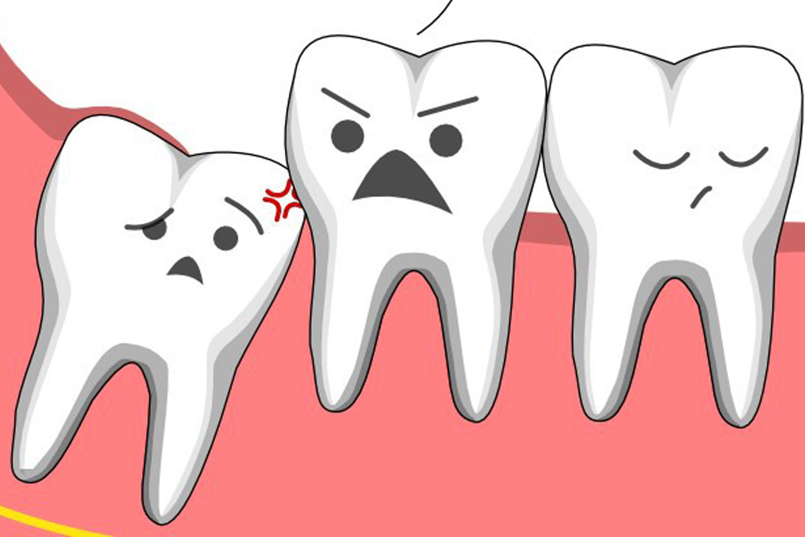 Tất tần tật mọi lưu ý khi nhổ răng khôn – Trước khi gặp bác sĩ bạn nhất định phải biết, tránh hiểm hoạ khôn lường - Ảnh 2.
