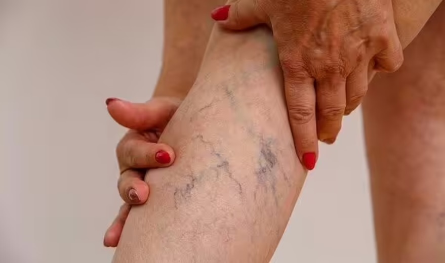 4 dấu hiệu cảnh báo cục máu đông trong cơ thể, nếu thấy cần đến viện 'ngay lập tức' - Ảnh 1.