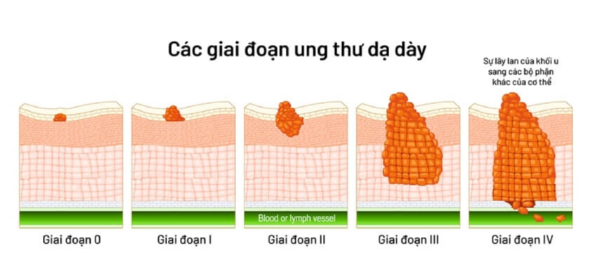 Thấy có biểu hiện này mỗi khi ăn, cảnh giác với dấu hiệu cảnh báo sớm của bệnh ung thư dạ dày - Ảnh 1. Thấy có biểu hiện này mỗi khi ăn, cảnh giác với dấu hiệu cảnh báo sớm của bệnh ung thư dạ dày - Ảnh 1.