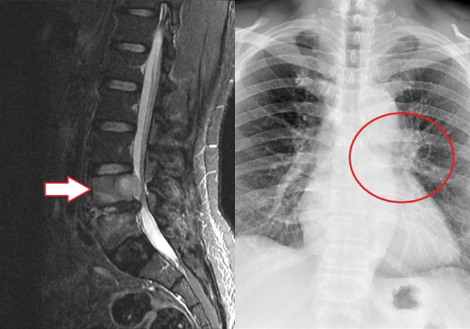 Đau lưng nên khám xương khớp, ai ngờ bị ung thư phổi “ăn mòn” 2 đốt sống - Ảnh 2.