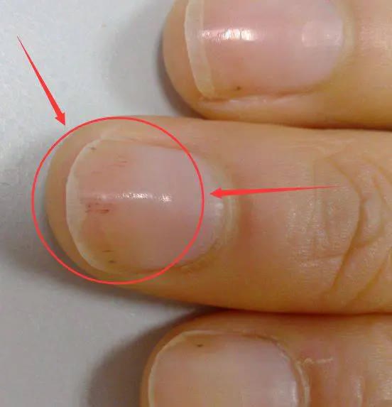 Bác sĩ cảnh báo trên móng tay có dấu hiệu này cần cẩn trọng với 5 loại bệnh và nên đi khám càng sớm càng tốt - Ảnh 3. Bác sĩ cảnh báo trên móng tay có dấu hiệu này cần cẩn trọng với 5 loại bệnh và nên đi khám càng sớm càng tốt - Ảnh 3.