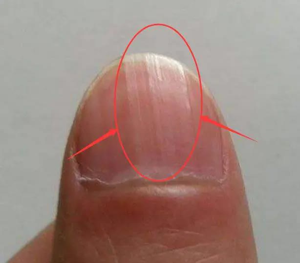 Bác sĩ cảnh báo trên móng tay có dấu hiệu này cần cẩn trọng với 5 loại bệnh và nên đi khám càng sớm càng tốt - Ảnh 2. Bác sĩ cảnh báo trên móng tay có dấu hiệu này cần cẩn trọng với 5 loại bệnh và nên đi khám càng sớm càng tốt - Ảnh 2.