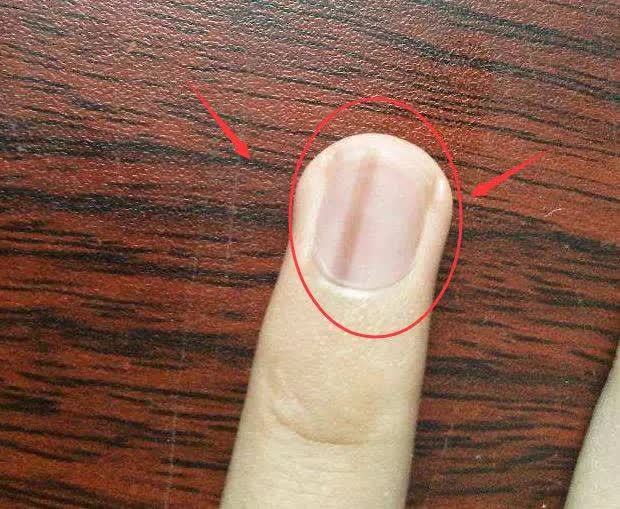 Bác sĩ cảnh báo trên móng tay có dấu hiệu này cần cẩn trọng với 5 loại bệnh và nên đi khám càng sớm càng tốt - Ảnh 4. Bác sĩ cảnh báo trên móng tay có dấu hiệu này cần cẩn trọng với 5 loại bệnh và nên đi khám càng sớm càng tốt - Ảnh 4.