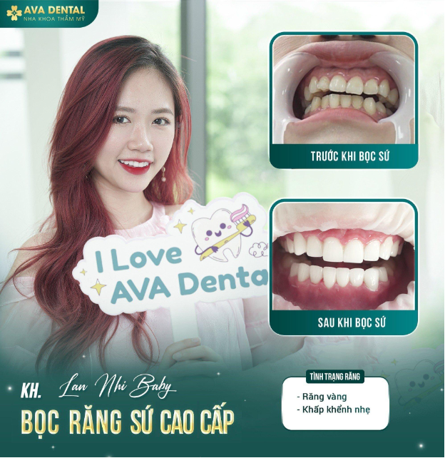 AVA Dental - Địa chỉ uy tín của Việt kiều làm răng sứ Orodent Bleach Innovation - Ảnh 3.