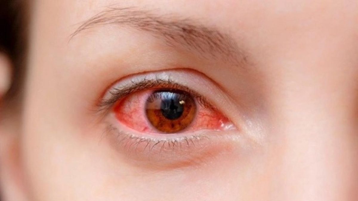 Đau mắt đỏ và một số vấn đề cần biết - Ảnh 1.