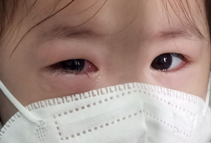Trẻ mầm non đi học giữa mùa dịch đau mắt đỏ: Bác sĩ khuyên những việc cần làm để phòng bệnh - Ảnh 2.