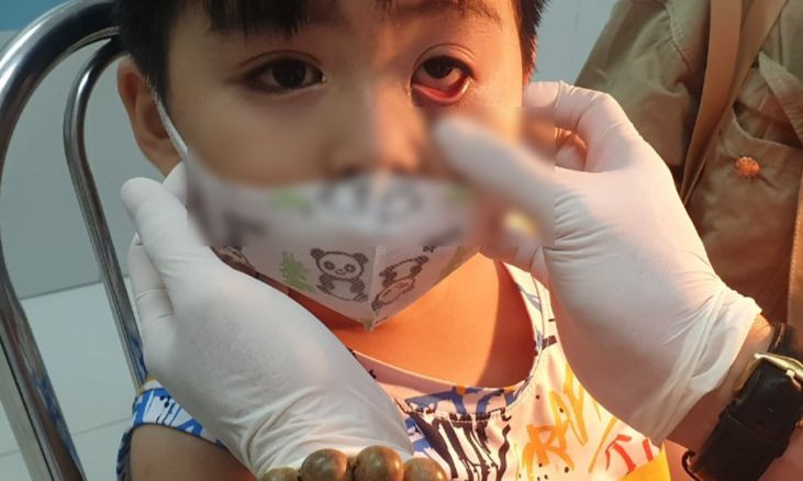 Trẻ mầm non đi học giữa mùa dịch đau mắt đỏ: Bác sĩ khuyên những việc cần làm để phòng bệnh - Ảnh 1.