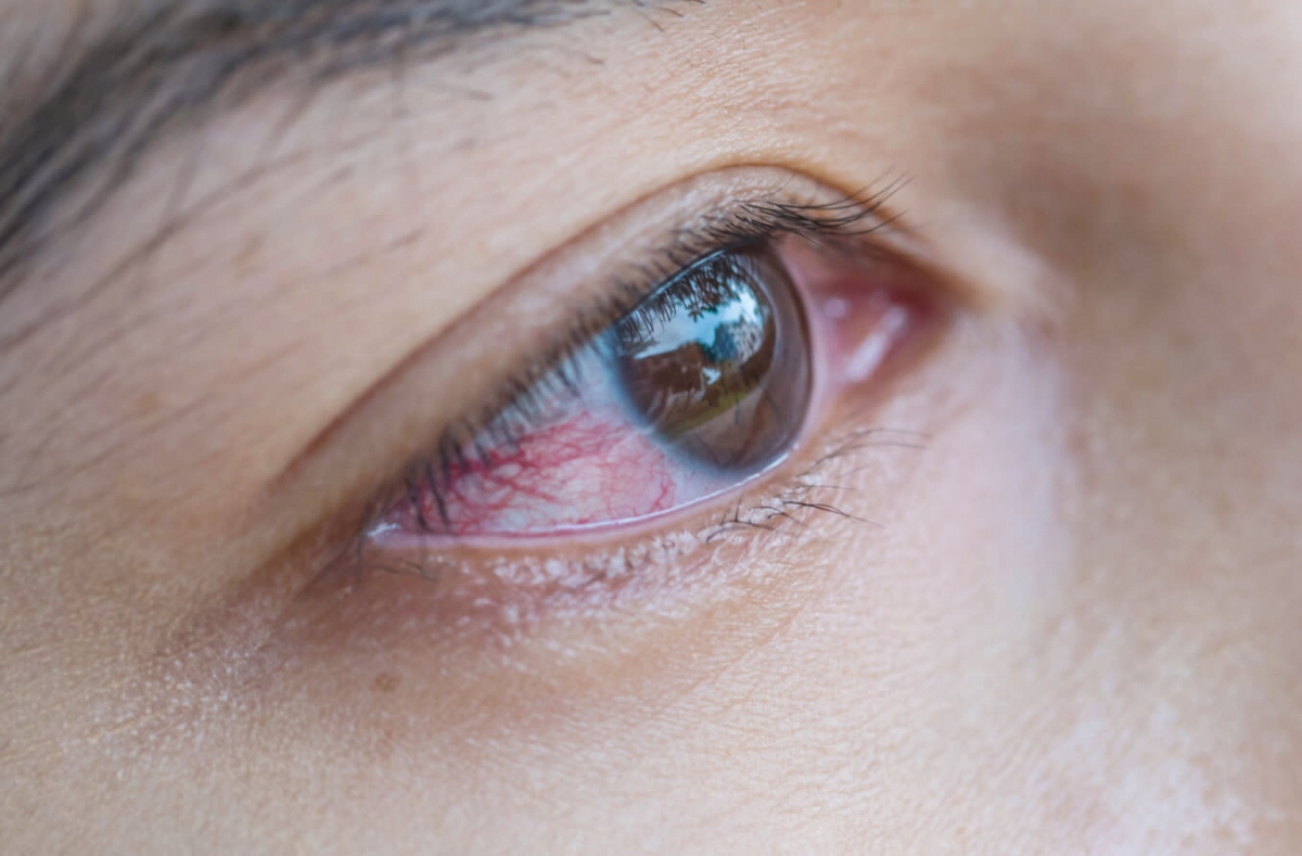 Các biện pháp khắc phục tại nhà cho bệnh đau mắt đỏ - Ảnh 1.