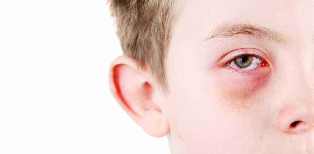 Các biện pháp khắc phục tại nhà cho bệnh đau mắt đỏ - Ảnh 2.