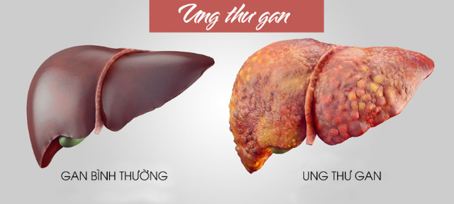 Con 13 tuổi đã mắc ung thư gan giai đoạn cuối, người mẹ ân hận vì không làm việc này sớm hơn - Ảnh 1. Con 13 tuổi đã mắc ung thư gan giai đoạn cuối, người mẹ ân hận vì không làm việc này sớm hơn - Ảnh 1.