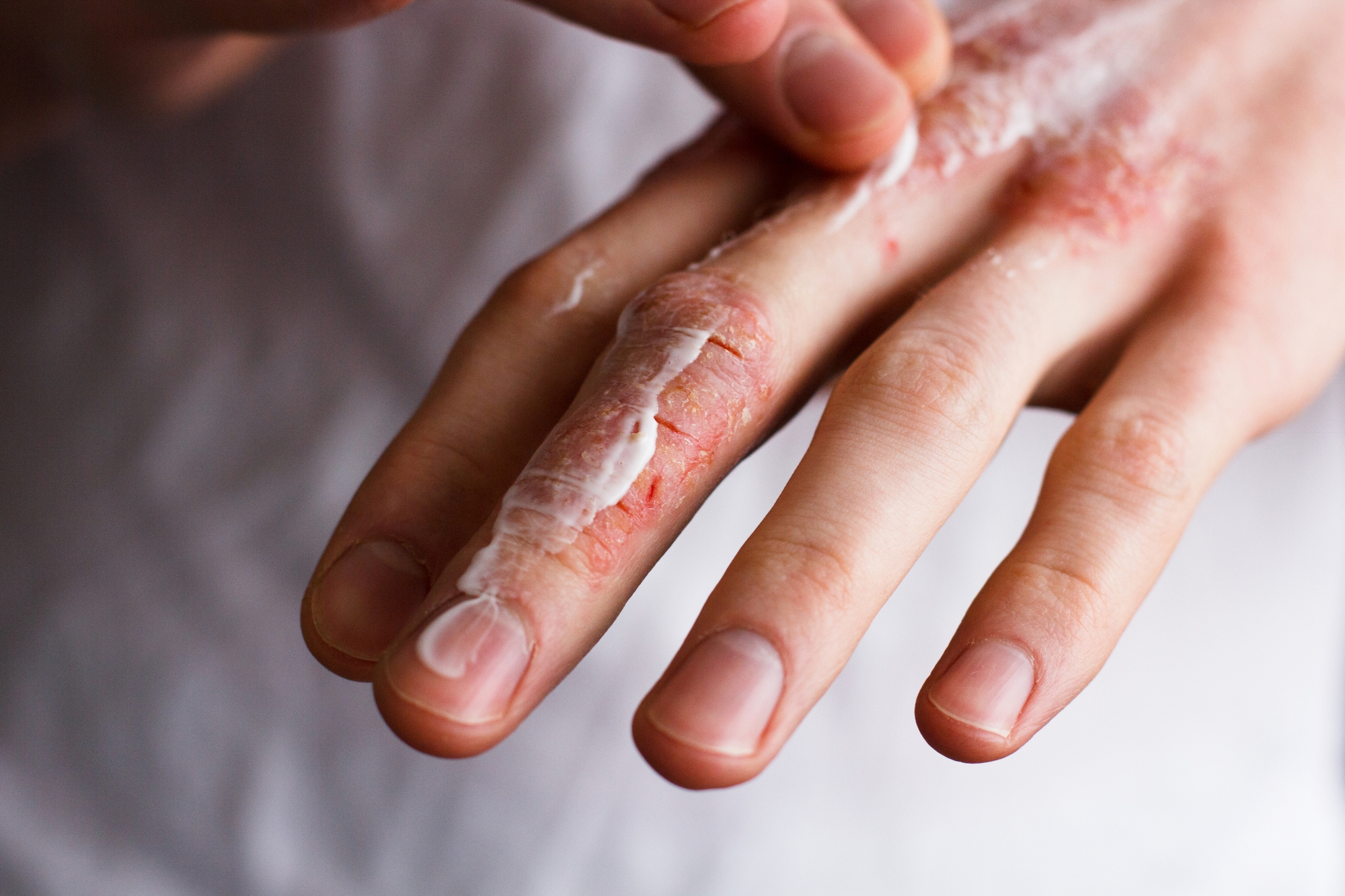 Viêm mô tế bào là gì? Những điều cần biết về tình trạng này- Ảnh 3. Viêm mô tế bào là gì? Những điều cần biết về tình trạng này- Ảnh 3.