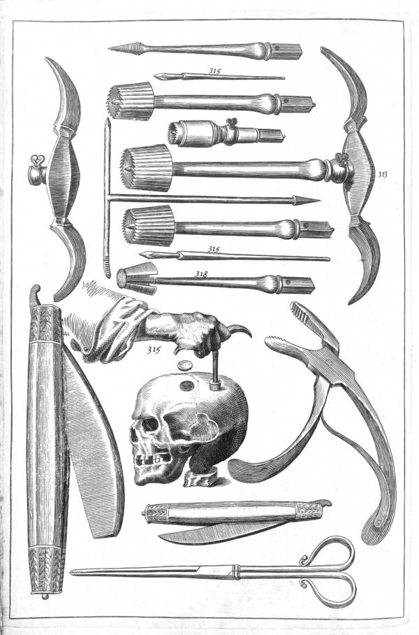 Trepanation: Thủ tục phẫu thuật sọ lâu đời nhất thế giới vẫn tồn tại đến ngày nay!- Ảnh 7.