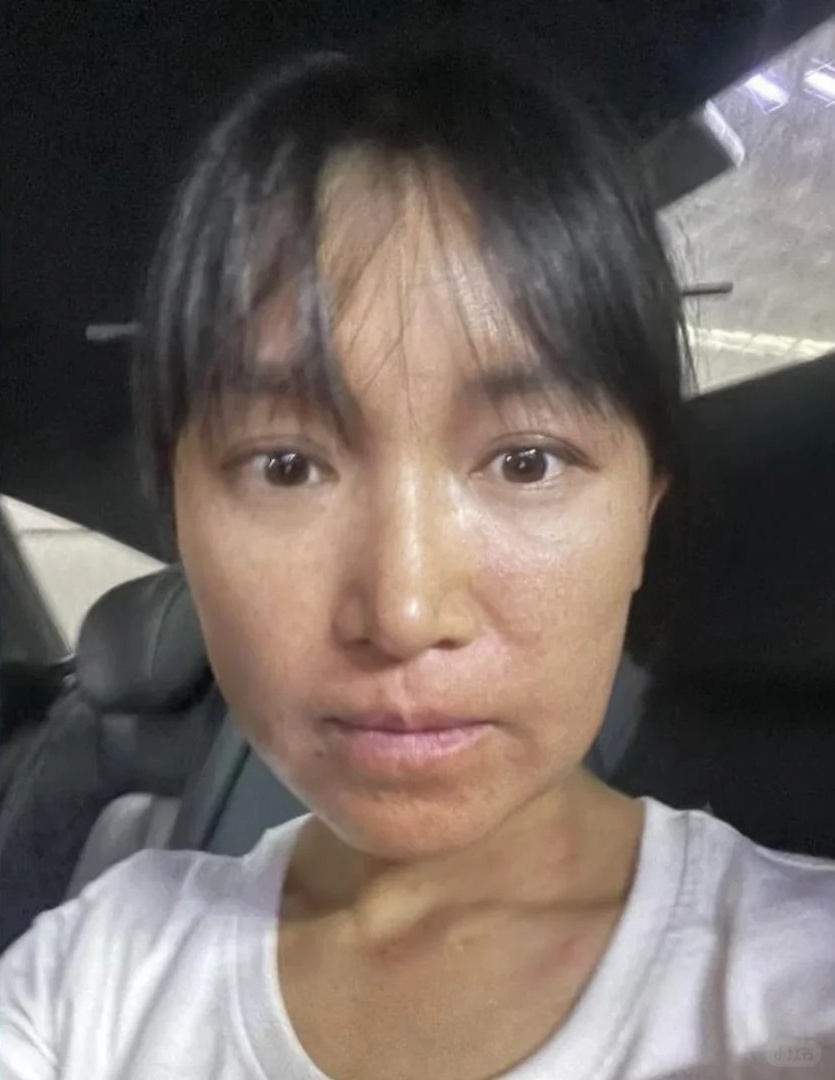 Lý Tử Thất công khai nhan sắc thật sau 3 năm ở ẩn gây choáng, làn da bị “huỷ hoại” giờ ra sao?- Ảnh 5. Lý Tử Thất công khai nhan sắc thật sau 3 năm ở ẩn gây choáng, làn da bị “huỷ hoại” giờ ra sao?- Ảnh 5.