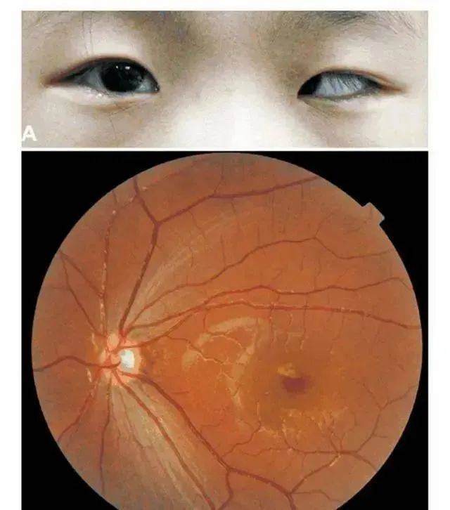 Xót xa đôi mắt của em bé 5 tuổi nghiện điện thoại- Ảnh 1.