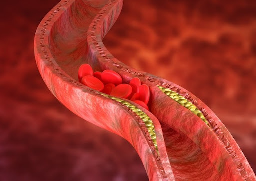 Sau Tết, đây là 9 cách giúp làm sạch mạch máu, giảm cholesterol rất nhanh- Ảnh 1. Sau Tết, đây là 9 cách giúp làm sạch mạch máu, giảm cholesterol rất nhanh- Ảnh 1.