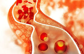 Dấu hiệu của cholesterol cao - "kẻ giết người thầm lặng" có thể xuất hiện ngay trên đầu mà bạn không để ý- Ảnh 1. Dấu hiệu của cholesterol cao - "kẻ giết người thầm lặng" có thể xuất hiện ngay trên đầu mà bạn không để ý- Ảnh 1.