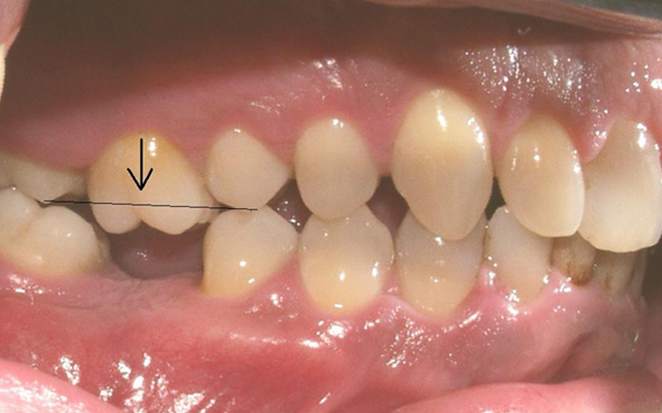 Bí mật về răng số 6: chiếc răng vĩnh viễn hay bị lãng quên và chưa được quan tâm đúng mức- Ảnh 3.