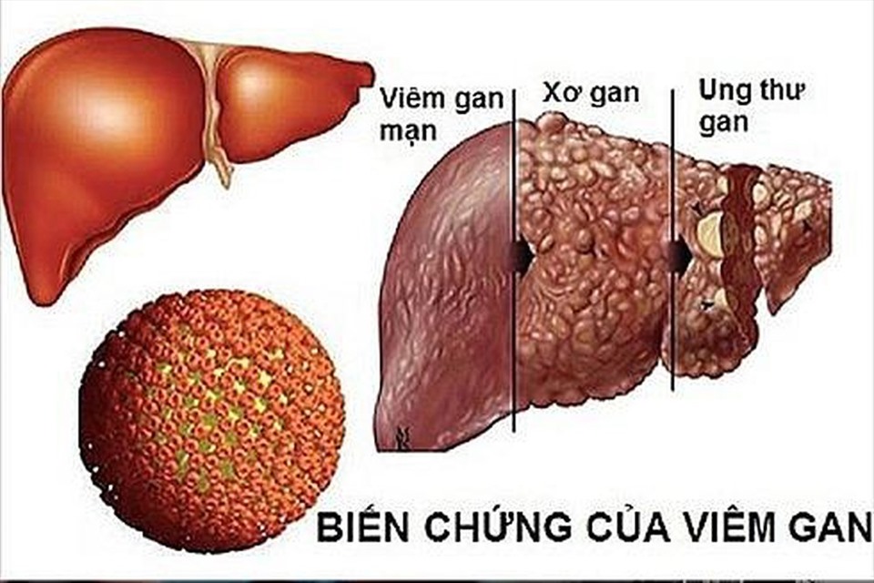 4 người trong gia đình cùng mắc ung thư gan, 3 người đã tử vong: BS chỉ ra căn nguyên gây bệnh hàng đầu- Ảnh 2.