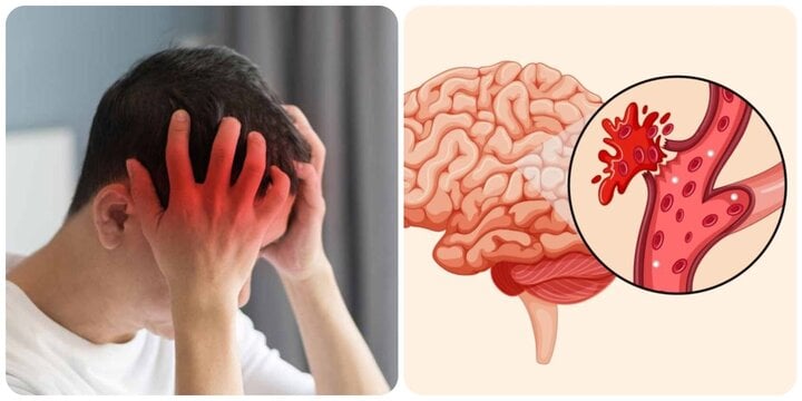 6 thói quen xấu dễ gây đột quỵ mùa hè, nhiều người không biết vẫn làm- Ảnh 1. 6 thói quen xấu dễ gây đột quỵ mùa hè, nhiều người không biết vẫn làm- Ảnh 1.