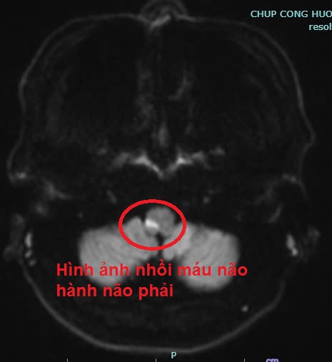 Tưởng say rượu, đi viện mới biết đột quỵ: Người đàn ông 41 tuổi gặp nguy hiểm vì chủ quan với 3 dấu hiệu- Ảnh 1. Tưởng say rượu, đi viện mới biết đột quỵ: Người đàn ông 41 tuổi gặp nguy hiểm vì chủ quan với 3 dấu hiệu- Ảnh 1.