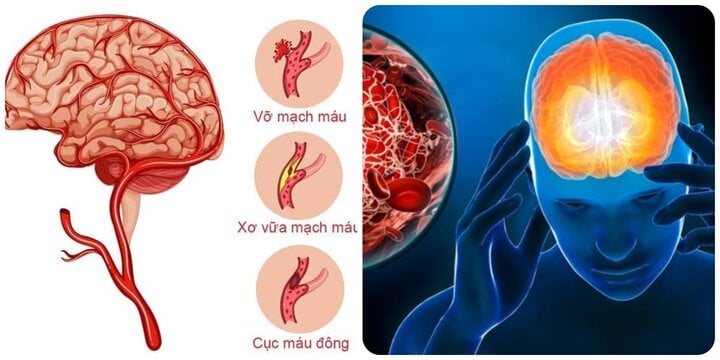 7 dấu hiệu cảnh báo cơn đột quỵ sắp xảy ra