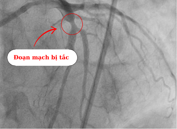 Ứng dụng kỹ thuật Hybrid điều trị tổn thương mạch vành phức tạp- Ảnh 1.
