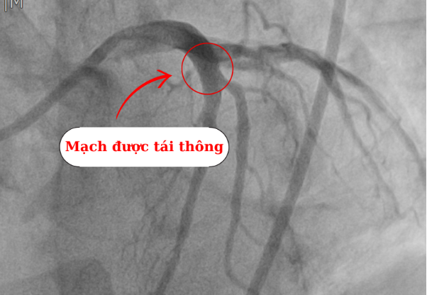 Ứng dụng kỹ thuật Hybrid điều trị tổn thương mạch vành phức tạp- Ảnh 2.