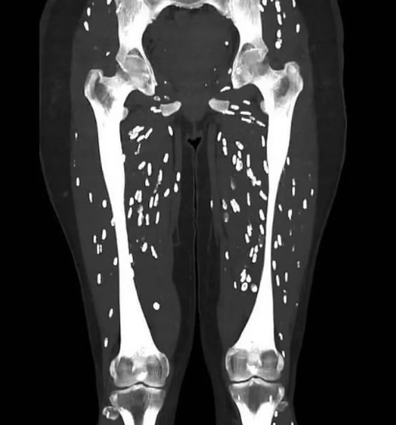 Sán làm tổ khắp người, tất cả do một kiểu nấu thịt lợn nhiều người Việt thường xuyên mắc phải- Ảnh 1.