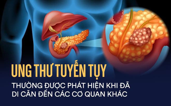 Ung thư tuyến tuỵ - ‘Vua’ của các loại ung thư quái ác nhất – có thể bắt nguồn từ 3 loại thực phẩm trong tủ lạnh nhà bạn- Ảnh 1.