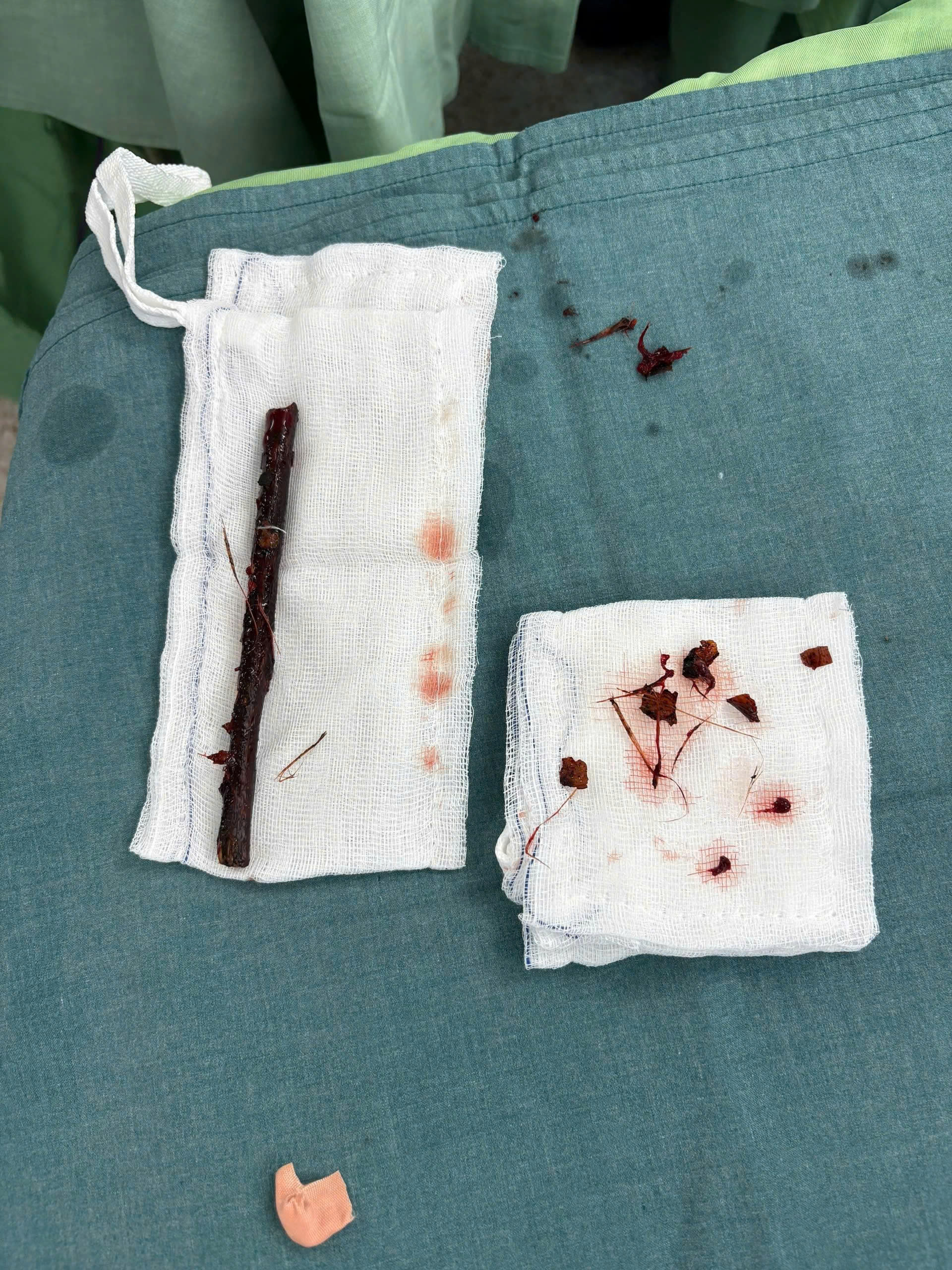 Hy hữu nhành cây dài 16 cm nằm trong bụng bé gái suốt 4 tháng Hy hữu nhành cây dài 16 cm nằm trong bụng bé gái suốt 4 tháng