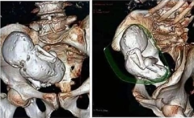 Chụp CT cho cụ bà 73 tuổi, bác sĩ sốc nặng khi phát hiện thai nhi hóa đá 30 năm - Ảnh 1.