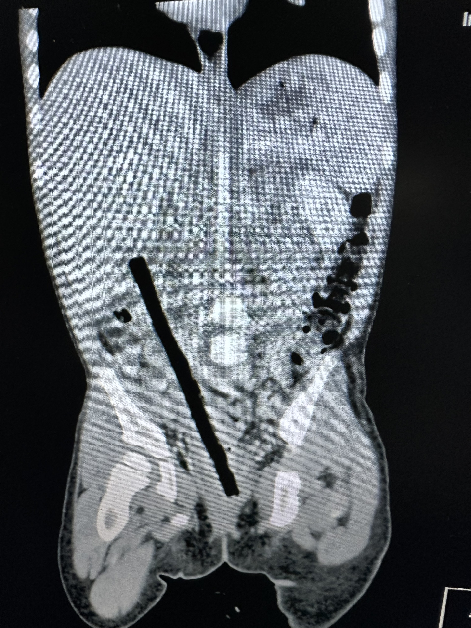 Hy hữu nhành cây dài 16 cm nằm trong bụng bé gái suốt 4 tháng Hy hữu nhành cây dài 16 cm nằm trong bụng bé gái suốt 4 tháng