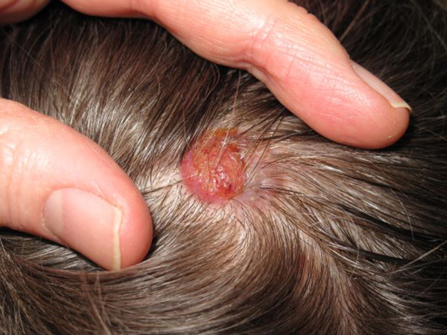 1 dấu hiệu ung thư chết người rất dễ bị nhầm lẫn với GÀU, xin đừng "nhắm mắt làm ngơ" nữa! - Ảnh 2.