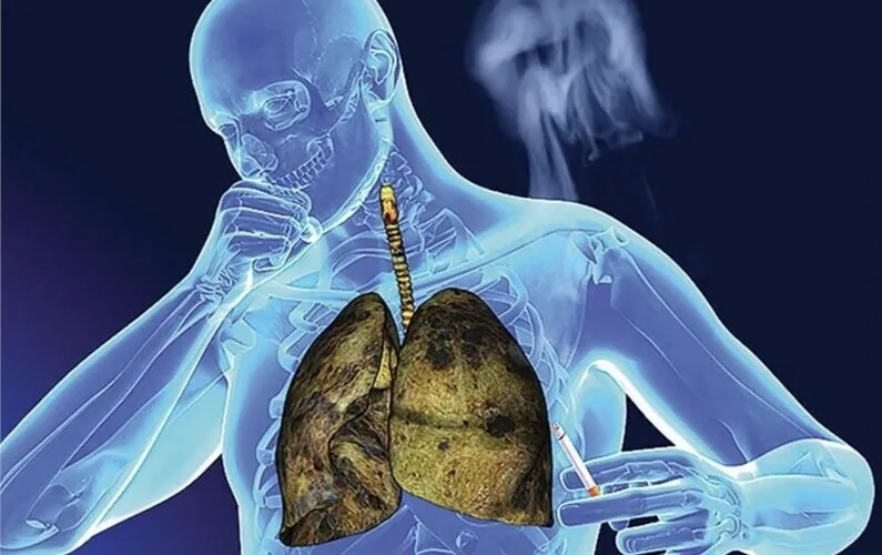 Đau vai tưởng bị bó cơ, tới khi kiểm tra phát hiện ung thư phổi: 6 tín hiệu cảnh báo KHẨN! - Ảnh 2.