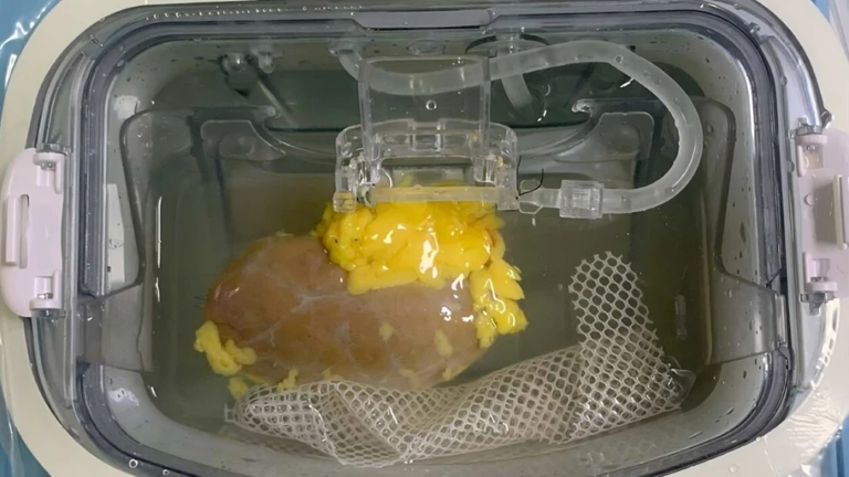 Tin vui cho người suy thận, cần ghép thận- Ảnh 1.