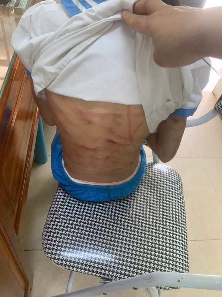 Xác minh thông tin bé gái lớp 5 bị cha dượng bạo hành - Ảnh 1.