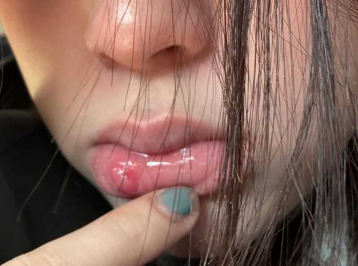 5 thay đổi ở môi đang CHỈ ĐIỂM ung thư dù nhiều người "không thèm để ý" - Ảnh 1.