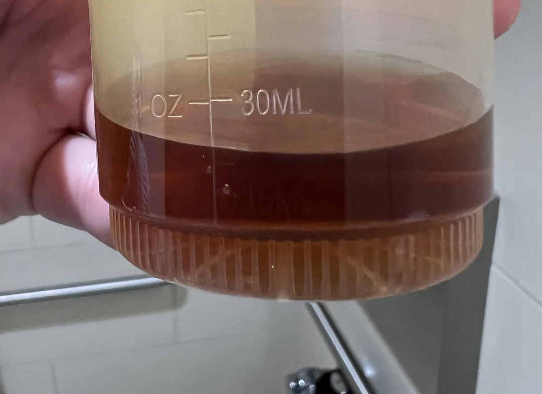 Sáng dậy nhận thấy 5 dấu hiệu này, chỉ sợ gan của bạn đã "xơ xác" như tổ ong! - Ảnh 2.