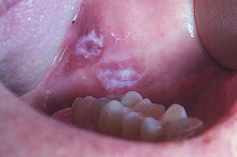 Nhiệt miệng mà có 3 đặc điểm này e rằng "che giấu" tế bào ung thư, khám ngay còn kịp!- Ảnh 2.