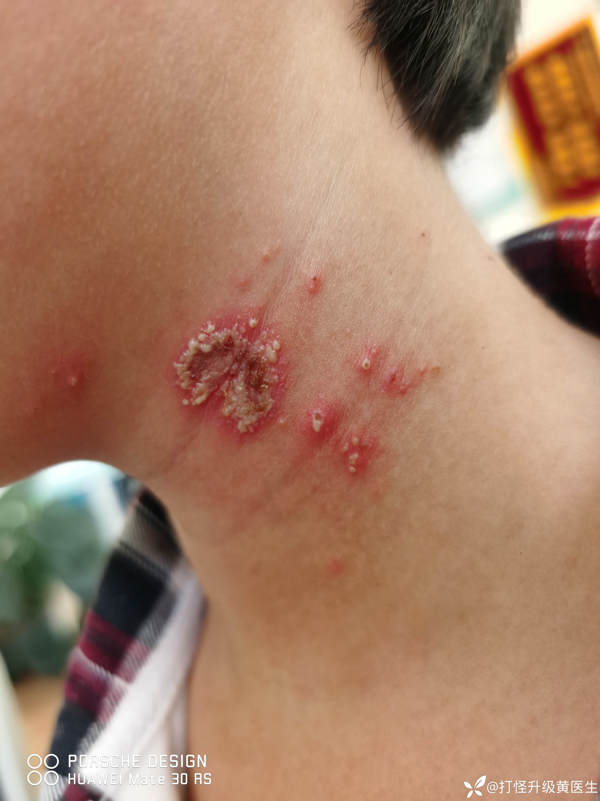 Bé trai 10 tuổi bỗng xuất hiện những nốt mẩn lạ trên da nhưng vẫn chưa tìm ra được nguyên nhân- Ảnh 1. Bé trai 10 tuổi bỗng xuất hiện những nốt mẩn lạ trên da nhưng vẫn chưa tìm ra được nguyên nhân- Ảnh 1.